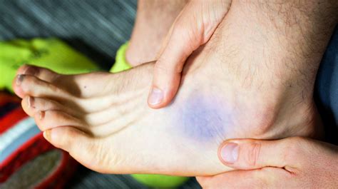Ankle Sprain Treatment For First Second And Third Degree Sprains