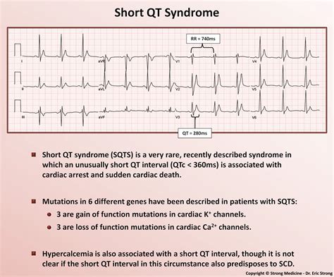 Short Qt Syndrome Short Qt Syndrome Sqts Is A Very Grepmed