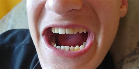 15 Years Old Teeth Outward Tilt Splayed Teeth Case Discussions