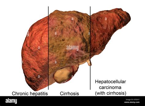 Hígado Humano Mostrando Las Etapas De La Enfermedad Hepática Y El Virus