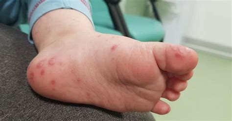 nurses share pictures of hand foot and mouth disease after case in rochdale manchester