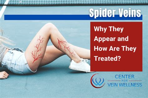Spider Veins Why They Appear And How Are They Treated