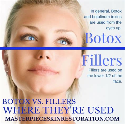 Botox Vs Fillers Which Will Work Best For You Free Infographic