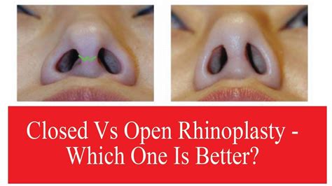 What Type Of Rhinoplasty Surgery Should You Consider The Esthetic