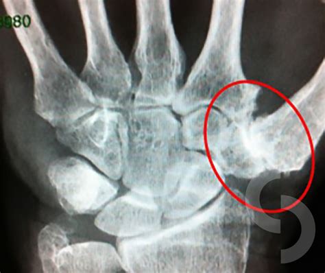 Picture 3 X Rays Of The Wrist Indicating Marked Arthritis Of The Thumb