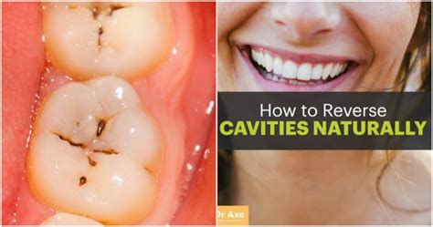 Simply swish a tablespoon of coconut oil in your mouth for 20 minutes until your saliva and the oil turn a milky white color. How to Reverse Cavities Naturally & Heal Tooth Decay With ...