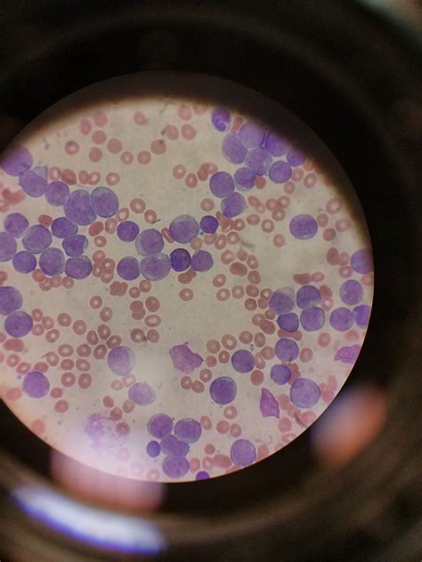 New Diagnosis Leukemia Way Too Many Blast Cells On Smear Medical