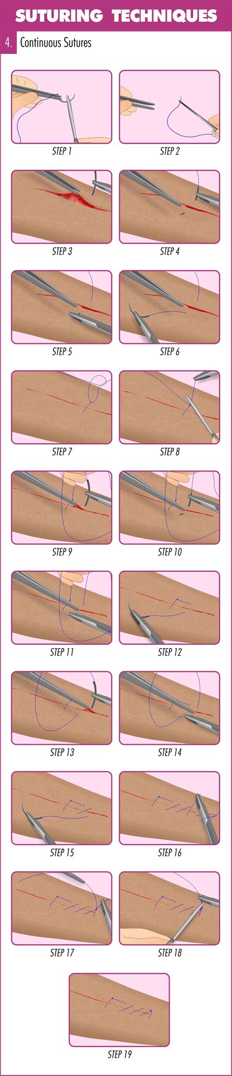 Complete Guide To Mastering Suturing Techniques