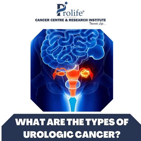 What Are The Types Of Urologic Cancers Prolife Cancer Centre