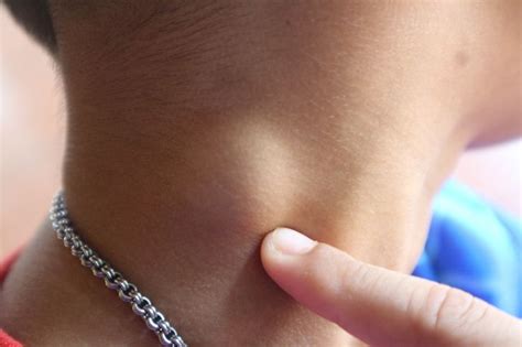 What You Need To Check Asap If You Have A Lump On Your Neck Or Behind