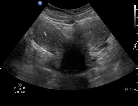 Uterus Didelphys Image