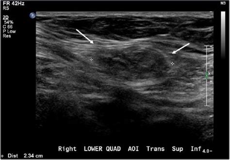 Sonographic Assessment Of A Spigelian Hernia Danielle J Dowdy Kelsy