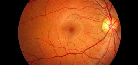 Retinal Photography Vista Optometry And Keratoconus Center Dennis Lin