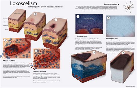 Loxoscelism Pathology By Strayfish On Deviantart