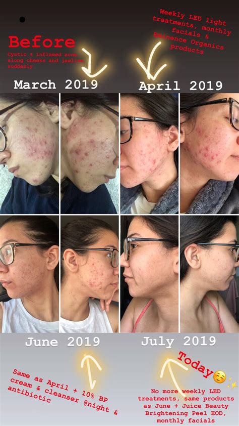 My Emotional Acne Journey From Cystic Acne To Acne Scarring Acne