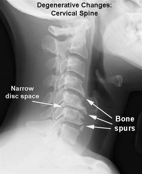 Bone spurs can cause nerve compression in your back. Neck Pain - Drwolgin