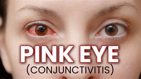 pink eye conjunctivitis infection in pakistan pinkeyeinfection eyehealth conjunctivitis