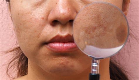 How To Recognize And Treat Melasma What You Should Know