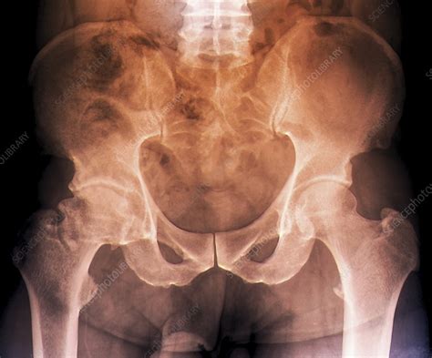 Osteoarthritis Of The Hip X Ray Stock Image C0095442 Science