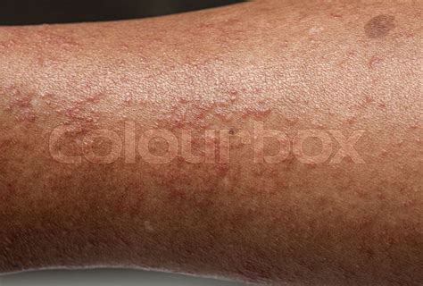 Strong Allergic Rashes On The Leg Dermatological Rash On The Skin And Body The Problem Of