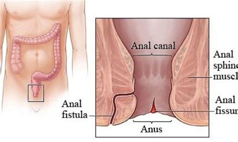 Homeopathic Remedy Anal Fissure Husband Picture