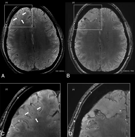 Ultra High Field Targeted Imaging Of Focal Cortical Dysplasia The
