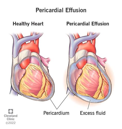 Pericardial Effusion Symptoms Causes And Treatment 54400 The Best