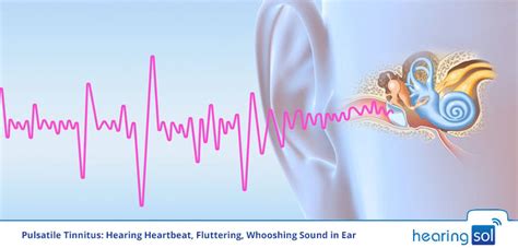 Pulsatile Tinnitus Stop Hearing Heartbeat Fluttering Sound