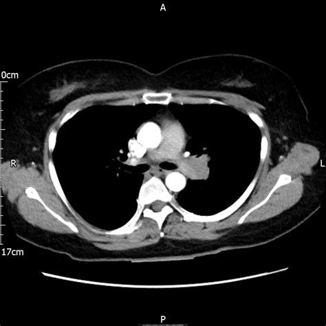 Diffuse Idiopathic Pulmonary Neuroendocrine Cell Hyperplasia With