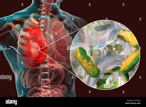 Pseudomonas Infection Hi Res Stock Photography And Images Alamy