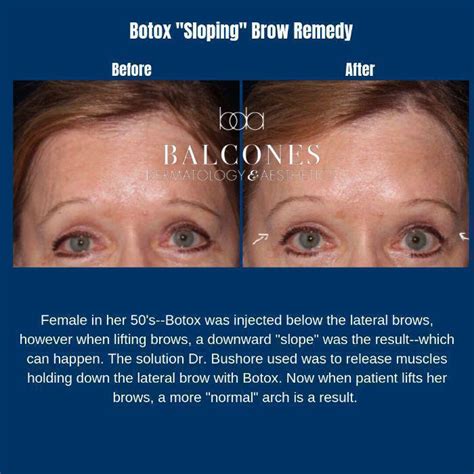 Botox Before And After Gallery Austin Tx Balcones Dermatology