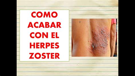 🔥 Como Curar El Herpes Zoster Con Remedios Naturales 👳‍♂🦊 Como Acabar