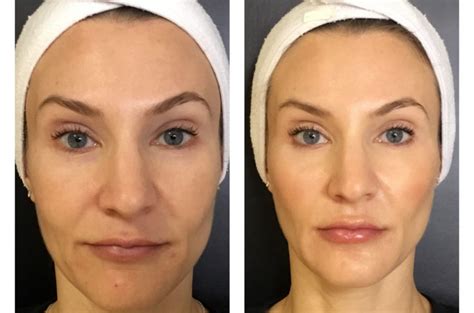 using dermal fillers to reverse the signs of aging alda aesthetics
