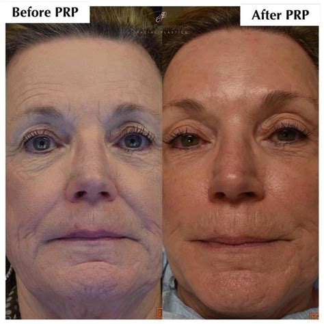 Microneedling With Prp Before And After Gallery Pennington
