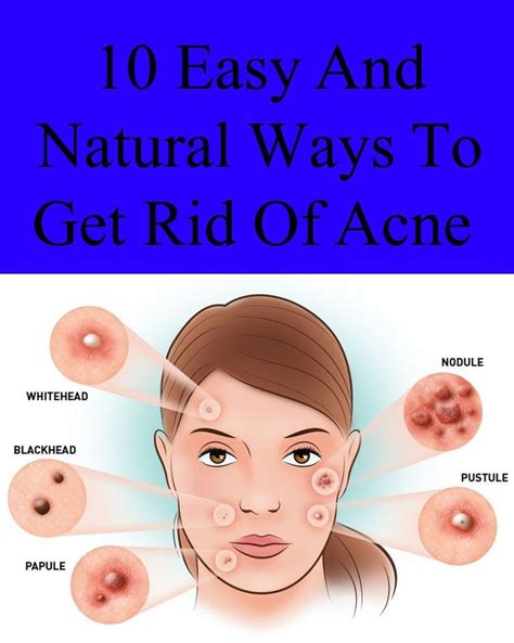 10 Easy And Natural Ways To Get Rid Of Acne Getridofzit How To Get