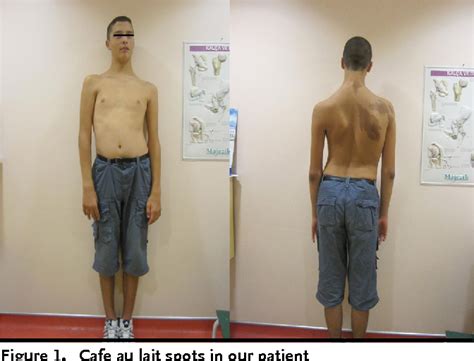 Know the causes, symptoms, treatment, prognosis, pathophysiology. PDF McCune Albright syndrome in association with ...