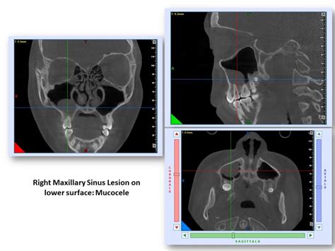 Cone Beam Computed Tomography CBCT OPDSF Orthodontics San