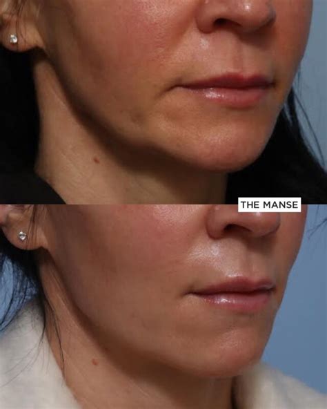Nasolabial Fold Filler Expert Doctors Injecting At Our Sydney Clinic