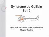 Afección rara por la que el sistema inmunitario del cuerpo ataca los nervios fuera del encéfalo y la médula espinal. Syndrome de Guillain Barré .PDF - ETUDE-AZ
