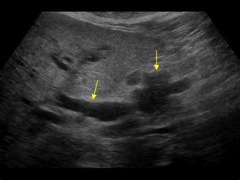 Abdomen And Retroperitoneum 13 Pancreas Case 131 Pancreatic Head