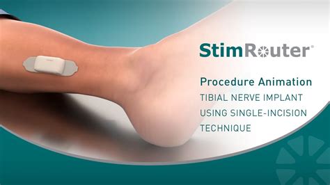 Stimrouter Procedure Animation Tibial Nerve Implant Using Single
