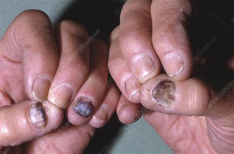 Psoriasis Of The Fingernails Stock Image C0494518 Science Photo