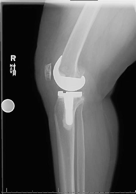 Postoperative Radiograph After Primary Tka With A 14 Â 30 Stem Which