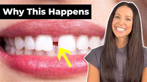 Why Do People Have Gap Teeth And How To Fix It Youtube Gap Teeth Why