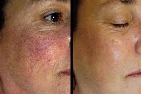 Broken Capillaries Treatment By Advanced Dermatology