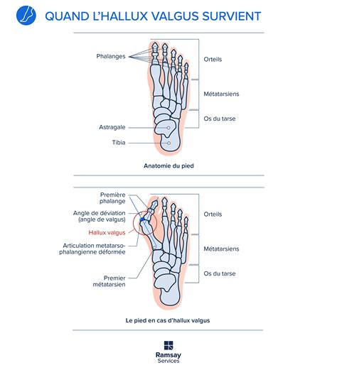 Hallux valgus ou oignon au pied quand le gros orteil dévie