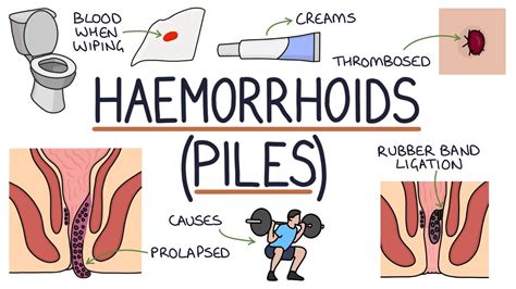 Understanding Haemorrhoids Youtube