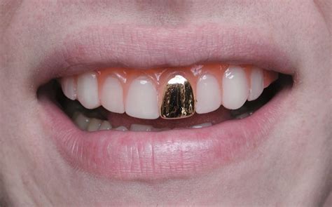 Gold Tooth Cap Gold Teeth Gold Tooth Cap Teeth Caps