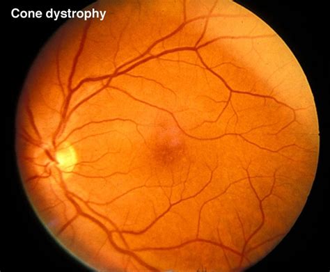 Figure 25 Fundus Photo Of Patient With Cone Dystrophy Webvision