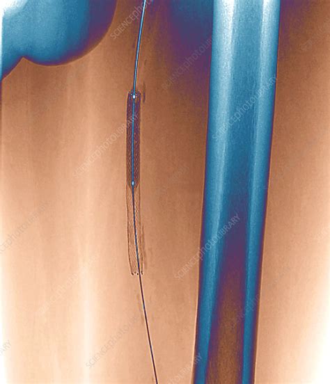 Femoral Artery Angioplasty Angiogram Stock Image M1750579